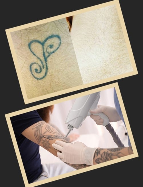 Лазерне видалення татуювань