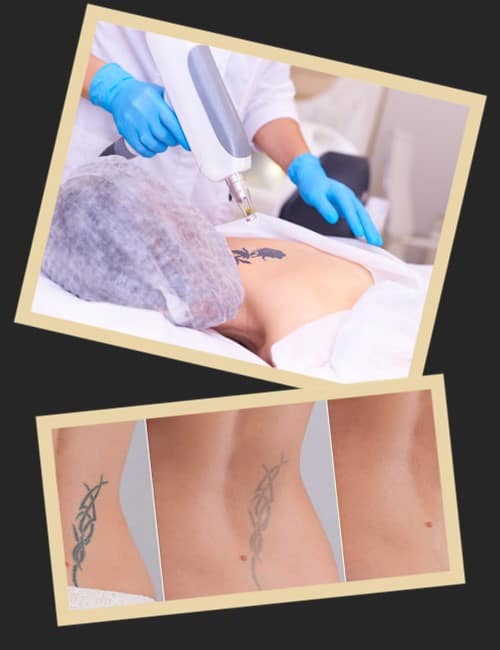 ефективність видалення татуювання