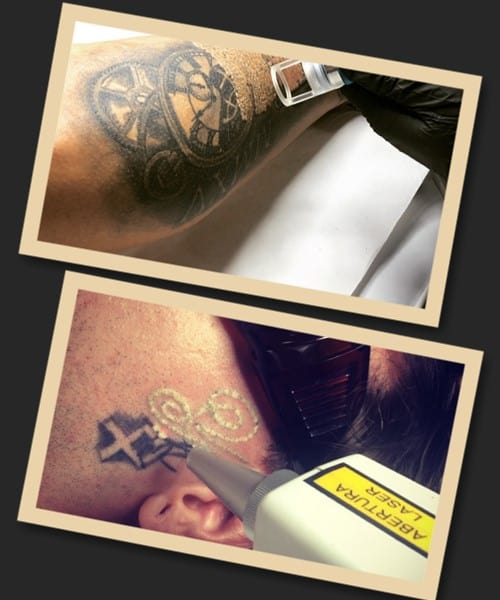 лазерний метод виведення тату