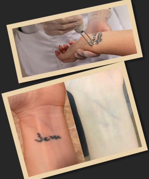 різні способи зведення татуювань