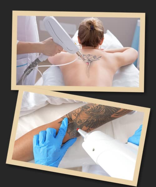 Способи видалення тату