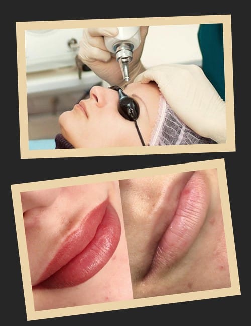 Як видалити татуаж?