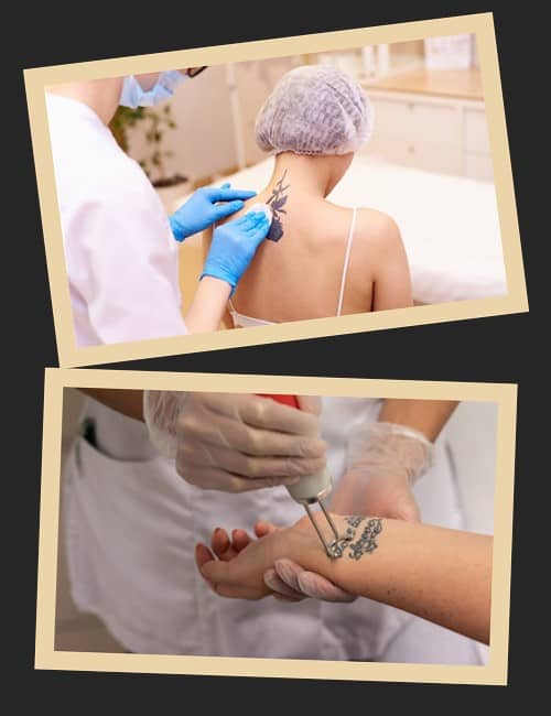 Якими способами можна звести татуювання