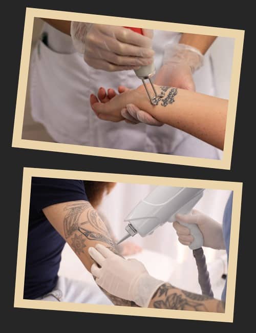 Як можна видалити татуювання