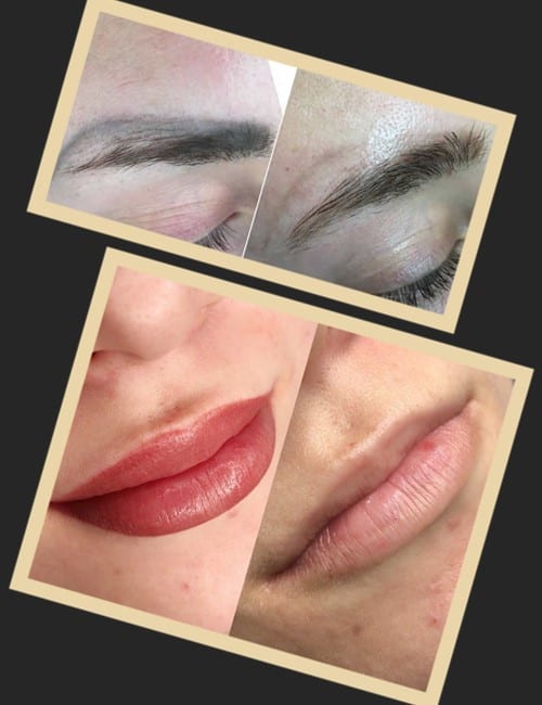 Як виконується видалення татуажу ревумером