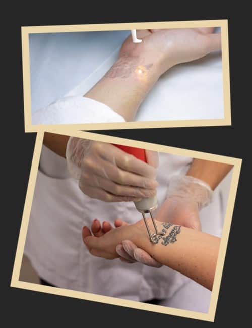 Методи видалення татуювань