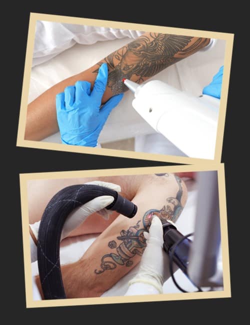 видалення тату лазером