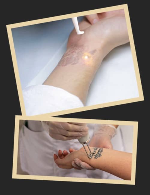 Сучасні техніки видалення татуювання