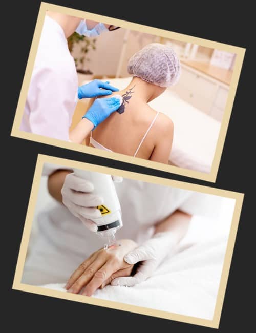 Як видаляють тату