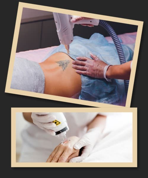 Методи видалення тату