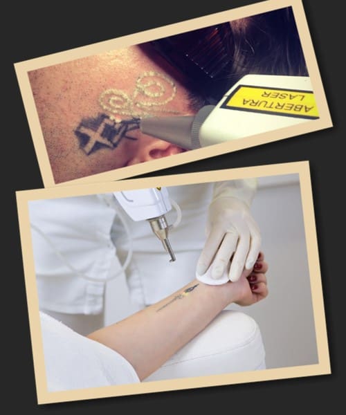 Основні методи видалення тату