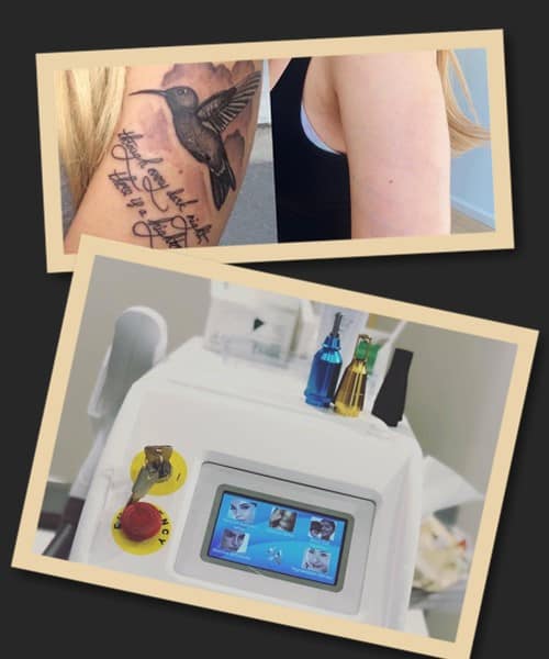 Чому варто вибрати лазерний метод для видалення тату