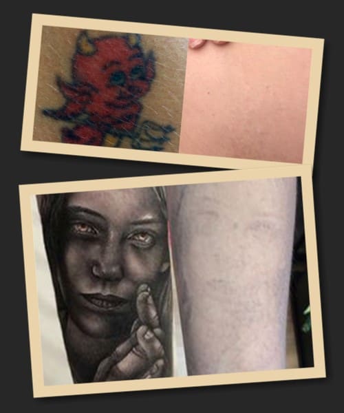 методи видалення тату