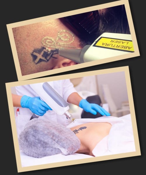 Як позбутися тату?