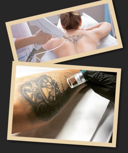 Методи видалення тату