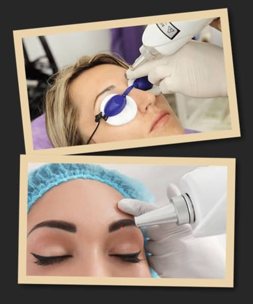 Особливості лазерної процедури видалення татуажу