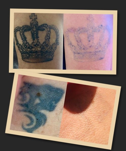 Електрокоагуляція видалення тату