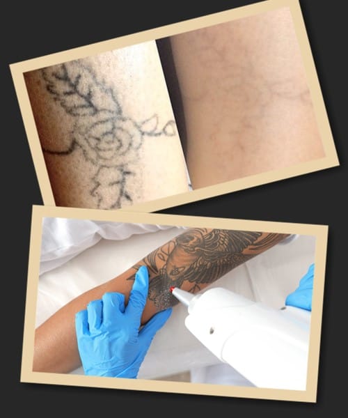Методи видалення татуювань
