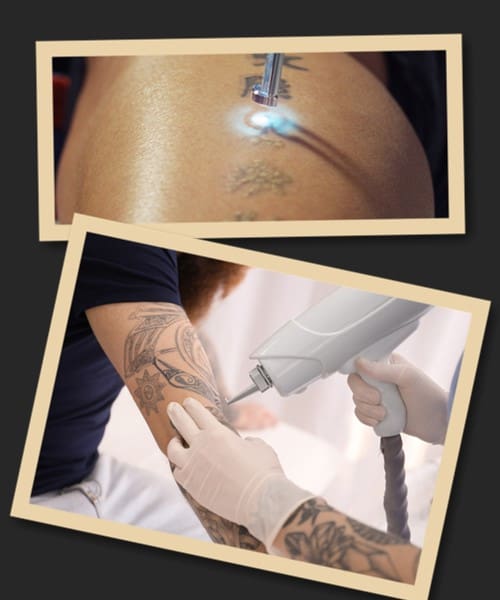 Принцип роботи лазерного методу видалення тату