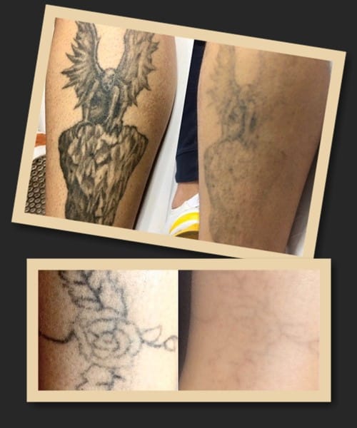 Як можна позбутися татуювання