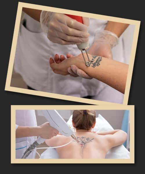 виведення тату