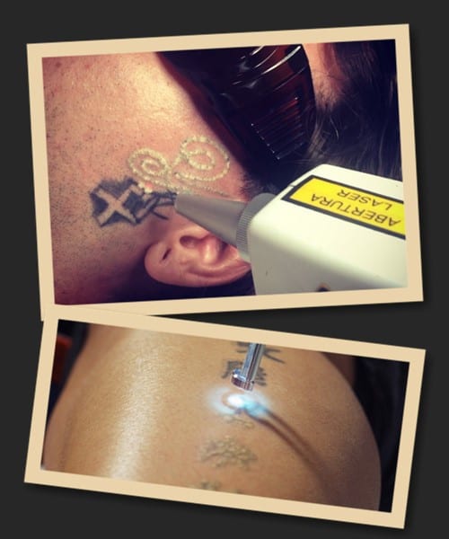 переваги лазерного методу виведення тату