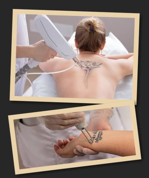 Методи видалення татуювань