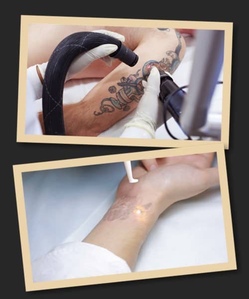 вартість видалення тату лазером