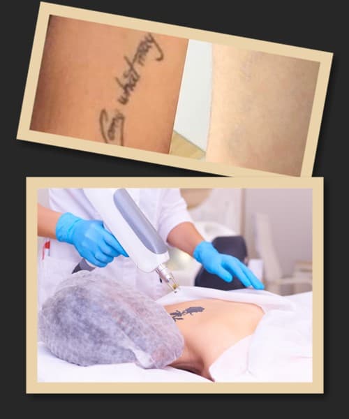 видалення тату