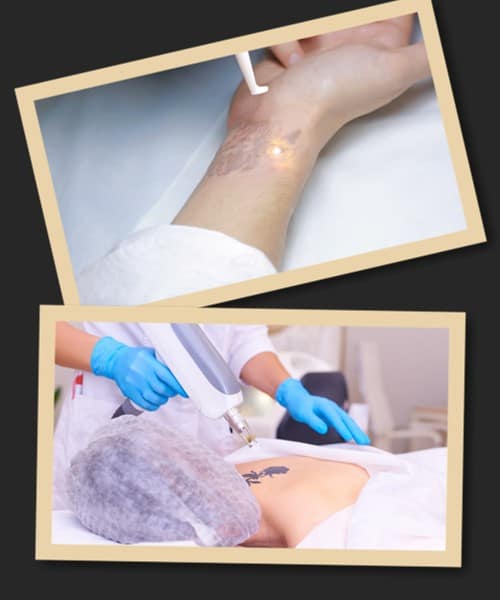 видалити татуювання лазером