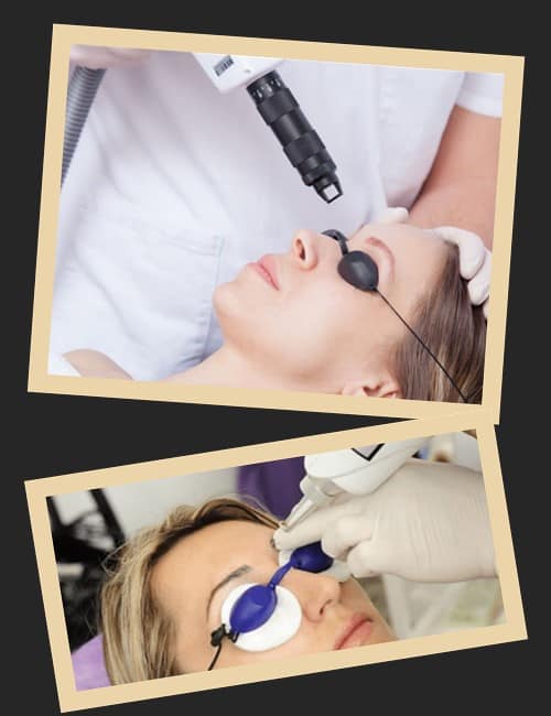 видалити татуаж брів у Києві