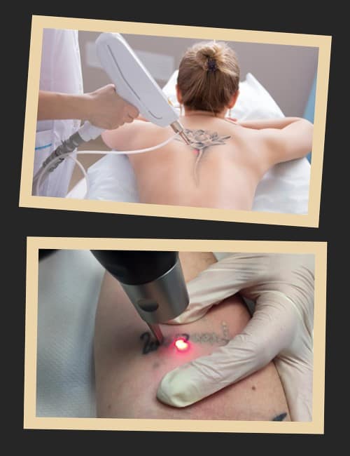 Лазерний метод виведення татуювань