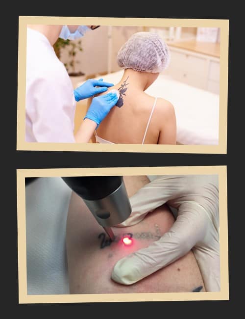 Чому лазерне виведення татуювань вважається найефективнішим