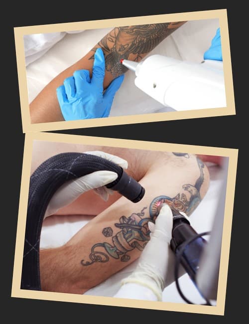 Переваги застосування лазера для виведення тату