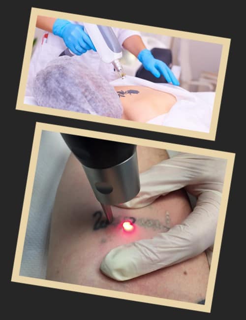 видалення тату лазером