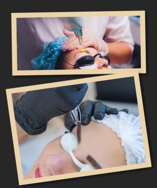 популярний метод видалення перманентного макіяжу брів у Києві – лазерний