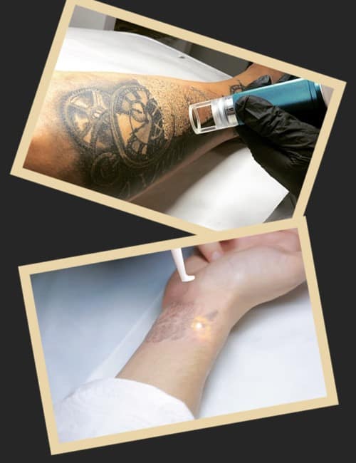 Як працює лазер та його переваги