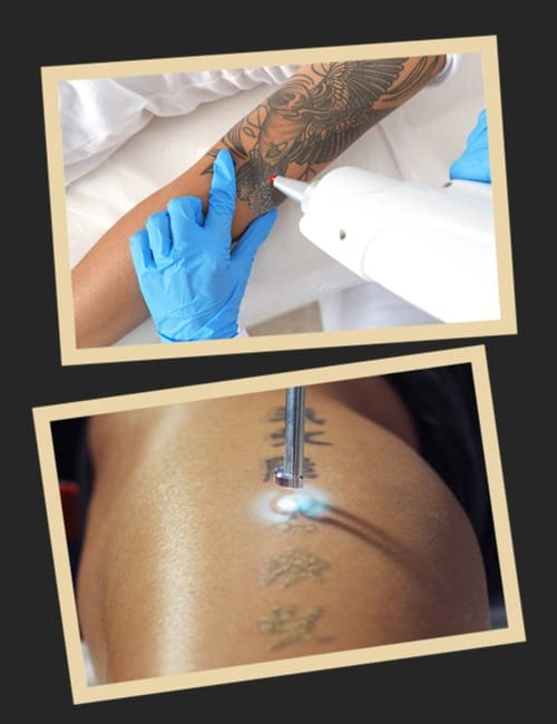 татуювання після лазера