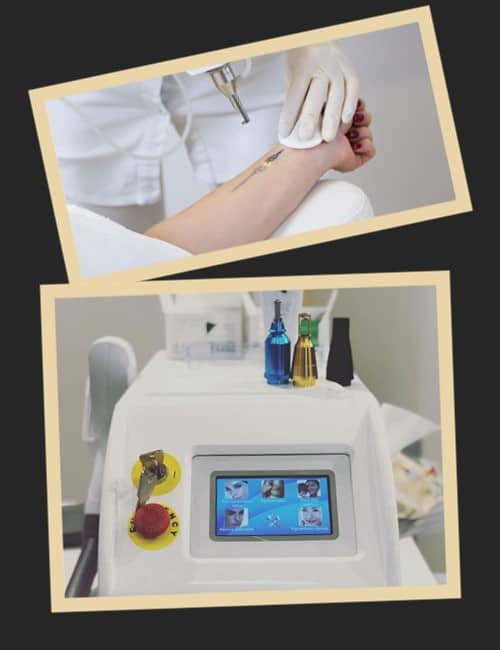 Татуювання після лазера