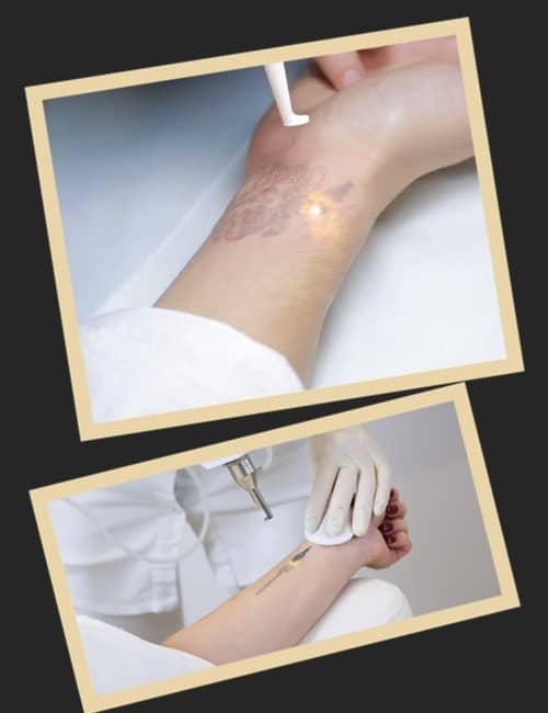 Особливості лазерного методу видалення тату