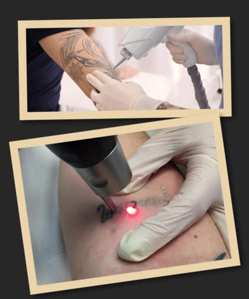 Зведення татуювань за допомогою лазера