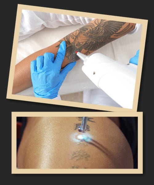 Чому лазерне виведення – найкраще