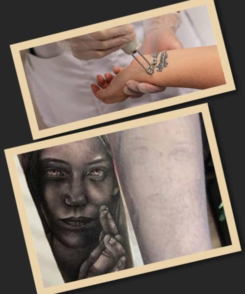 принци лазерного видалення тату