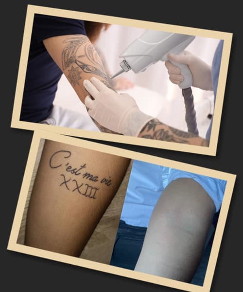 Способи видалення татуювань