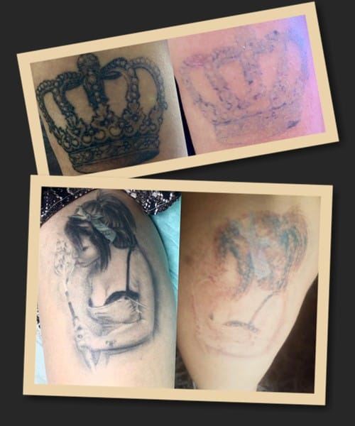 видалити тату без шраму