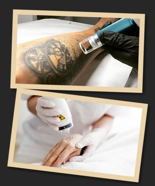 видалити тату лазером