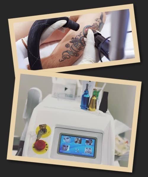 Зведення татуювань за допомогою лазера