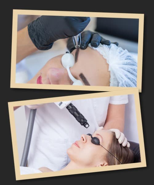 якісне видалення татуажу брів