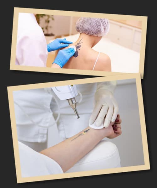 Лазерний спосіб видалення тату