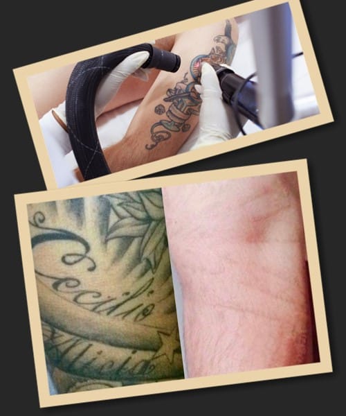 лазерний метод найбільш прийнятний для зведення татуювань